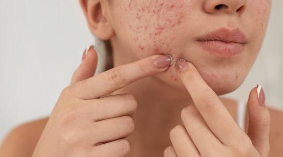 Pessoa com acne